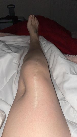 Patient shows leg after healing from limb salvage surgery