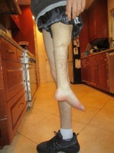Male stands in kitchen showing leg with rotationplasty