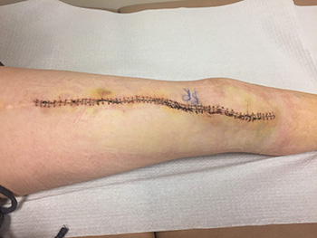 Patient shows leg after limb salvage surgery