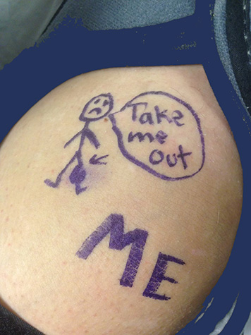 Patient with marker on leg indicating where a tumor is located prior to it's removal